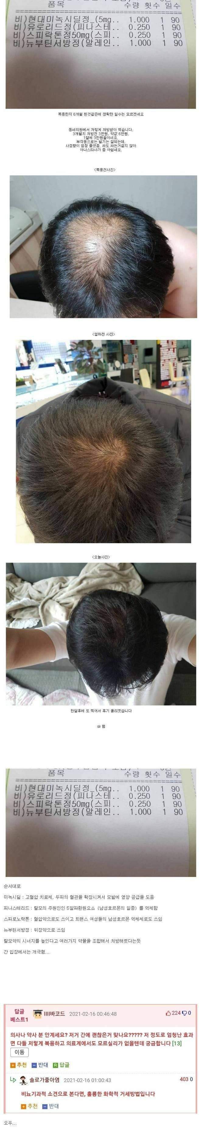 감탄만 나오는 탈모약 후기