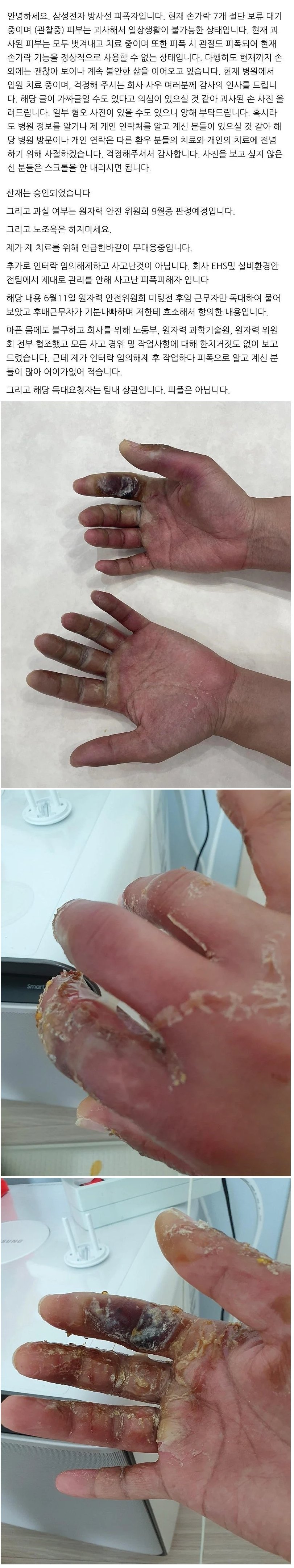 혐오주의)삼성전자 기흥공장 방사능 피폭자