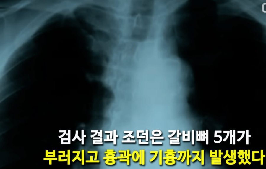 친구 밀어버린 미친년