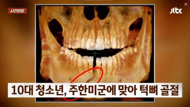 주한 미군 주먹에 10대 학생 '턱뼈' 부 서져