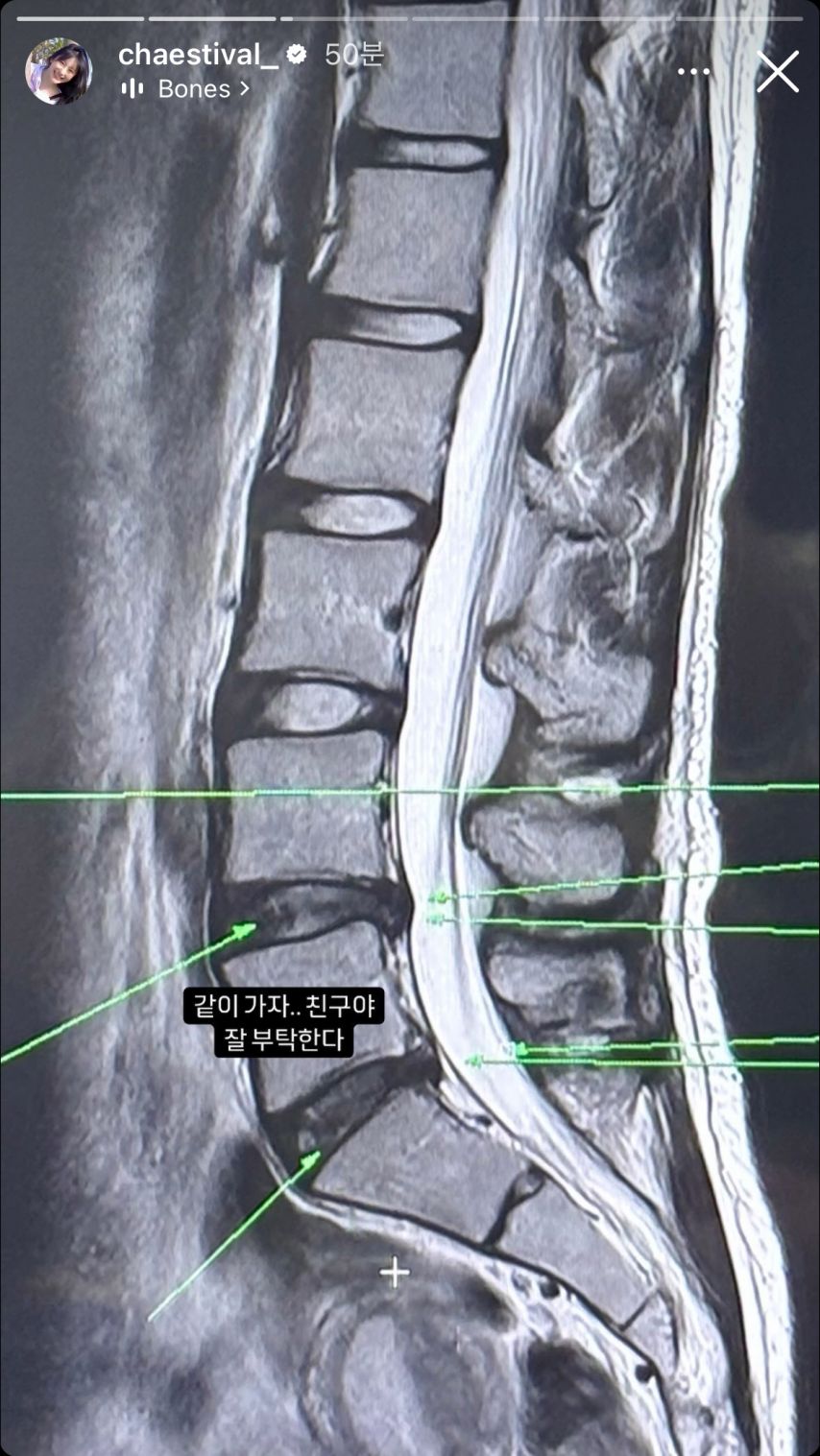 이채연..허리디스크로 당분간 댄스 휴식 [정보글]