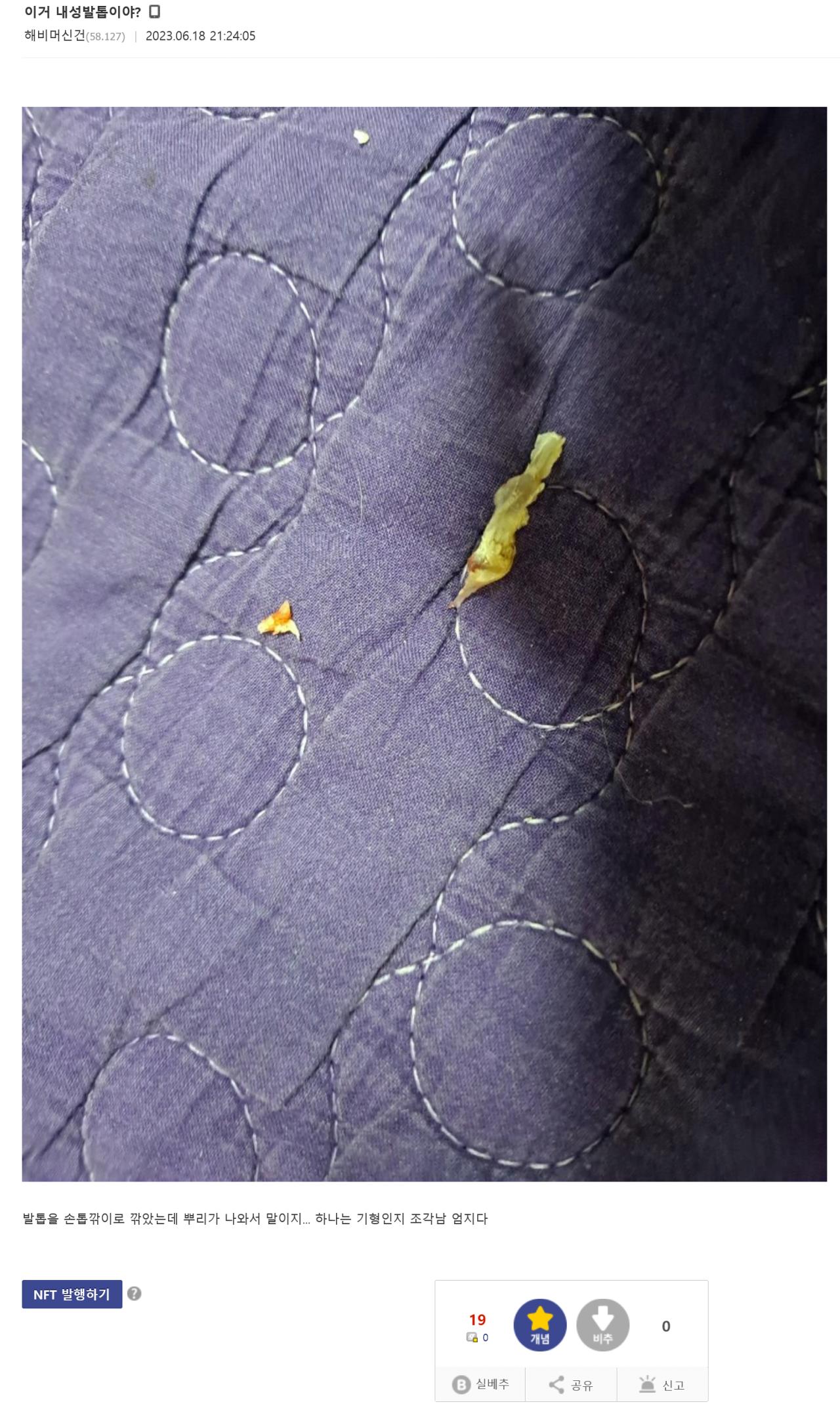 혐)내성발톱 갤러리 레전드