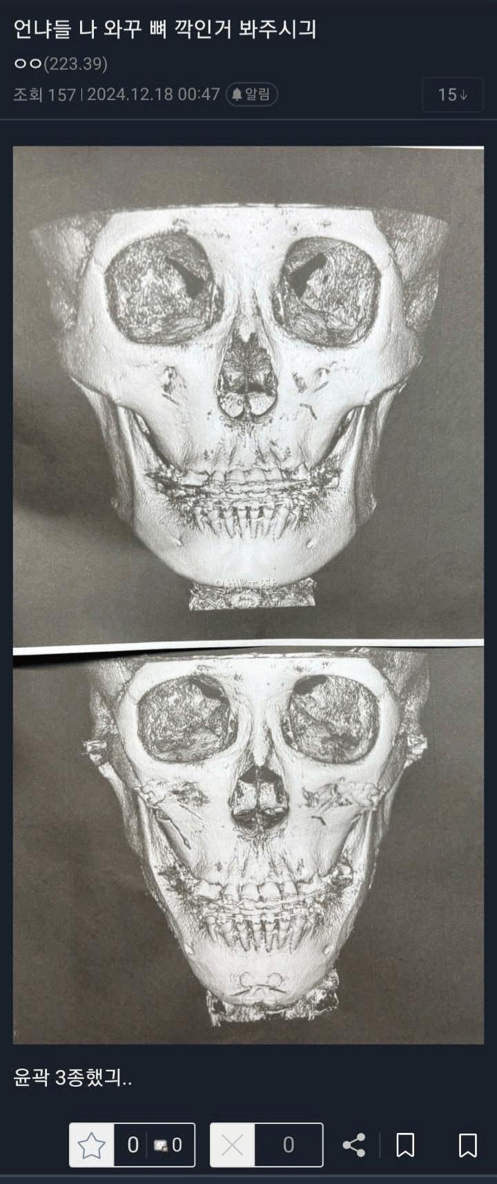 성형수술 레전드