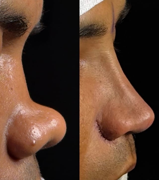 인스타에서 화제된 해외 코성형 전후