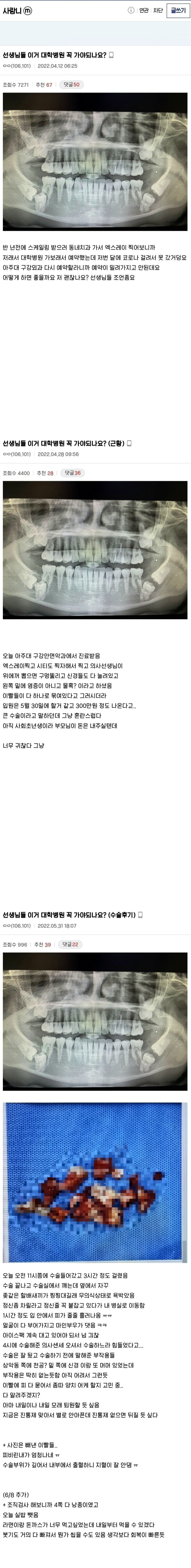 (약혐) 사랑니 수술 레전드