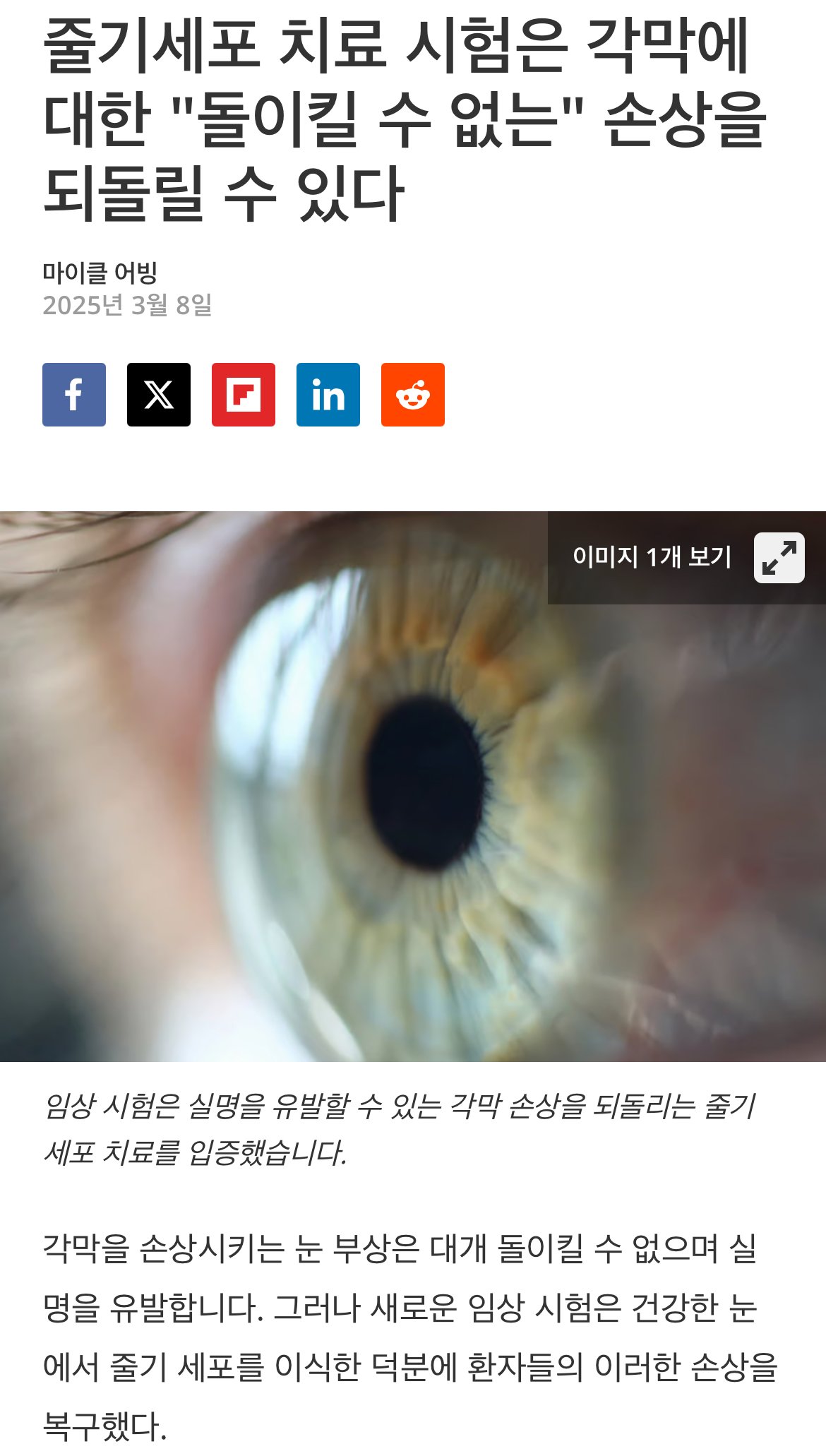 줄기세포로 불가능했던 각막치료 성공 근황 ㅎㄷㄷㄷ