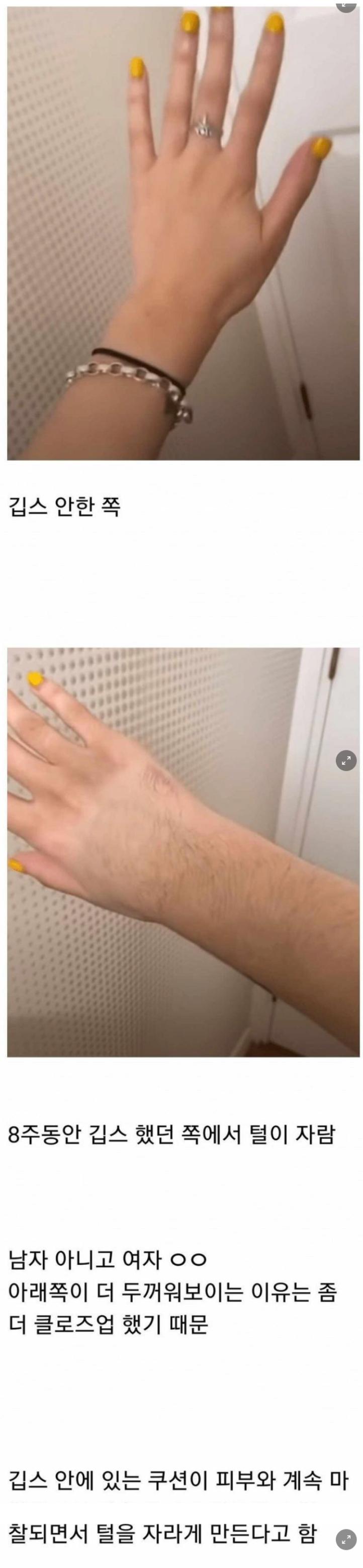 깁스 풀고 난 여자의 후유증