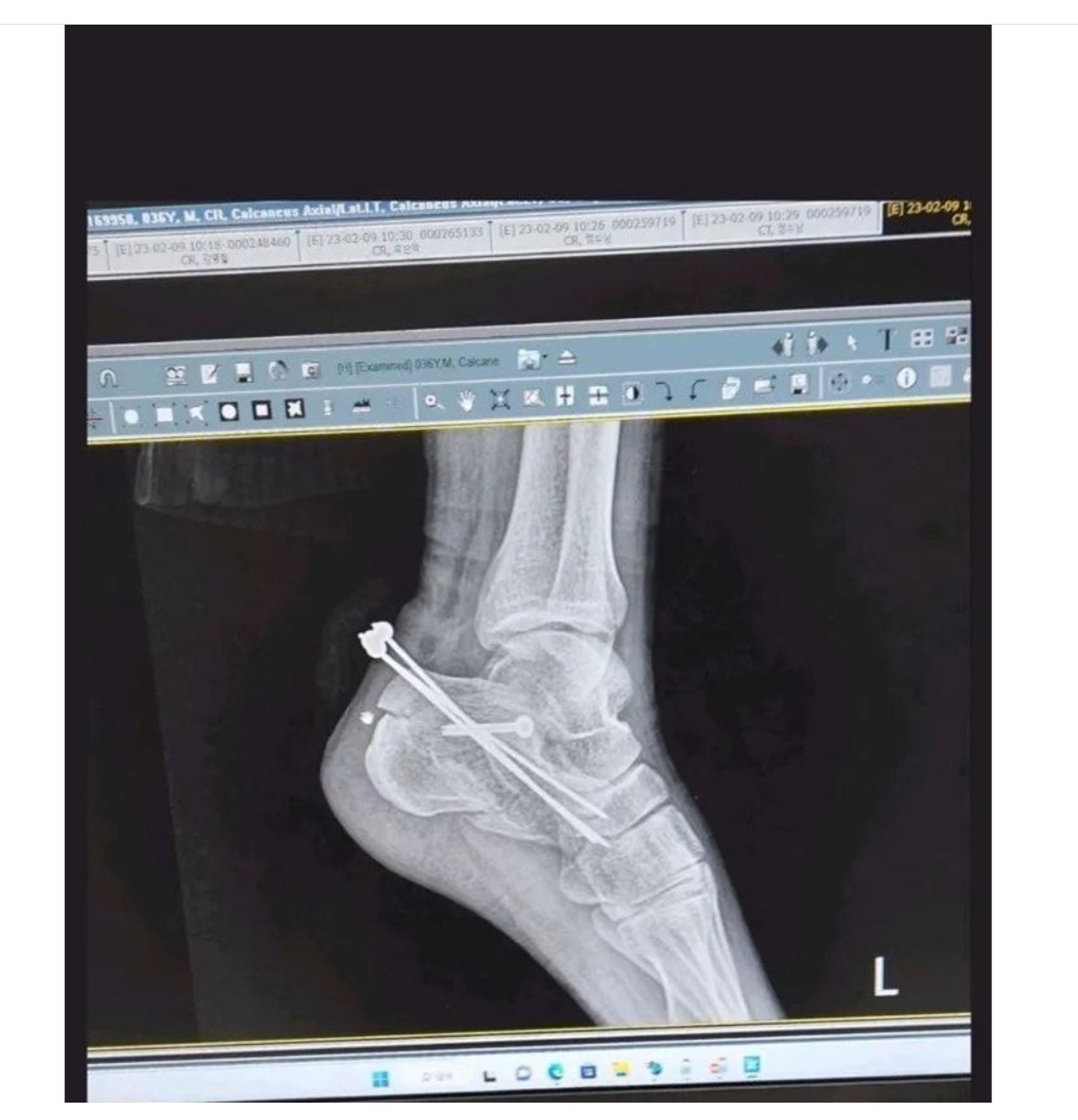 약혐) 집에서 손으로 철심 뺀 사람..