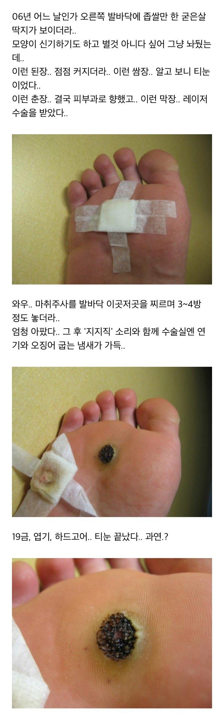 극혐주의) 스압) 사마귀 완치한 사람의 과정