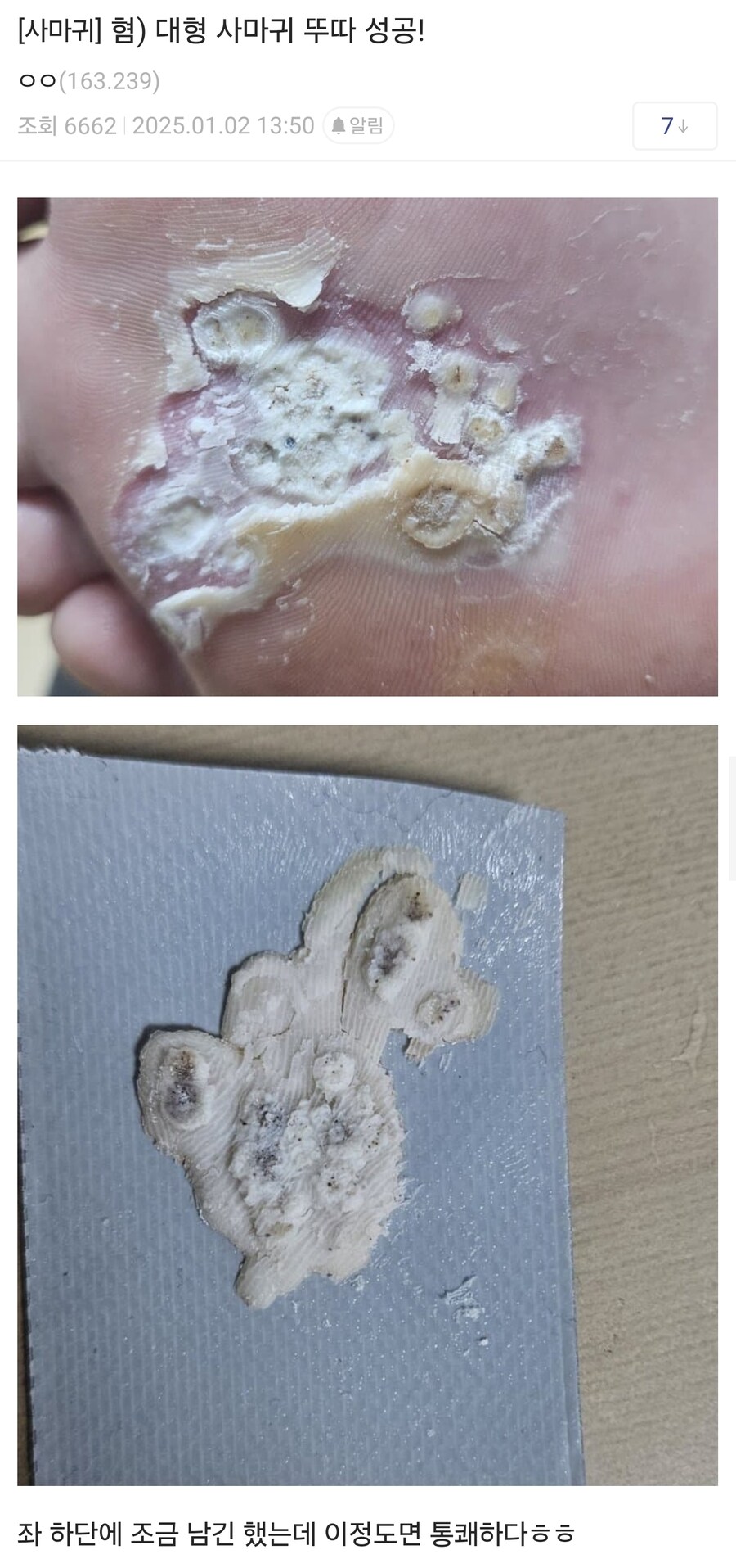 극혐)티눈갤 오마카세