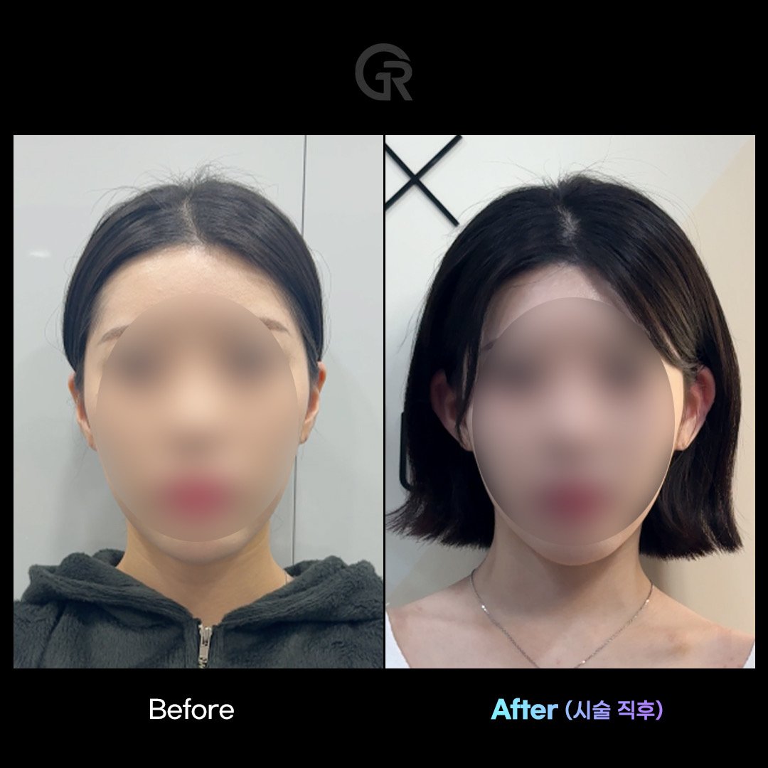 요즘 유행하는 귀 필러 시술 ㄷㄷ