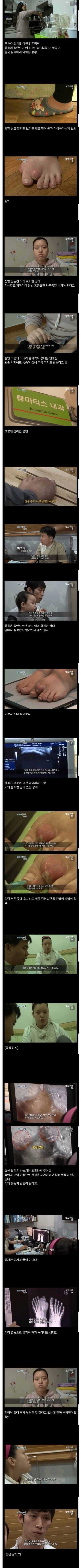 통풍 참고 살았다 발가락 뼈가 녹아 없어진 환자