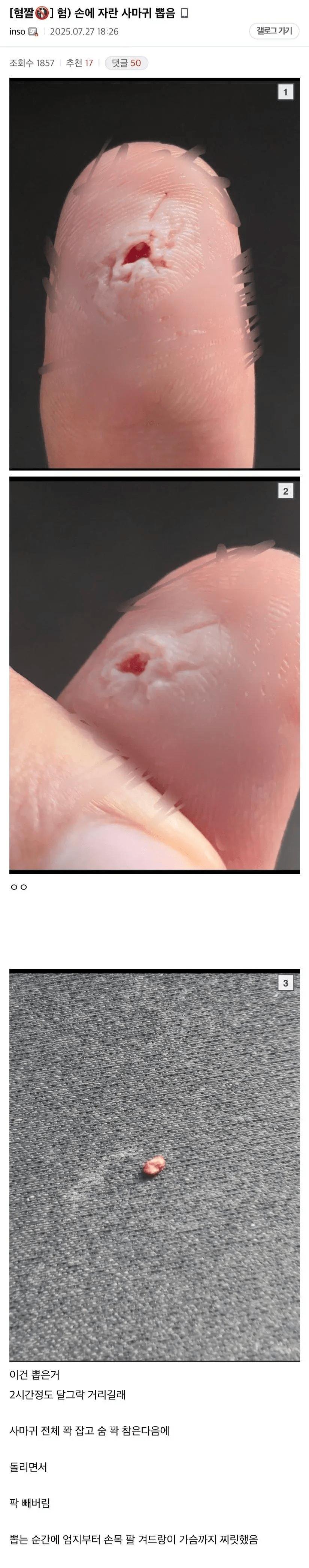 혐) 손에 자란 사마귀 뽑음