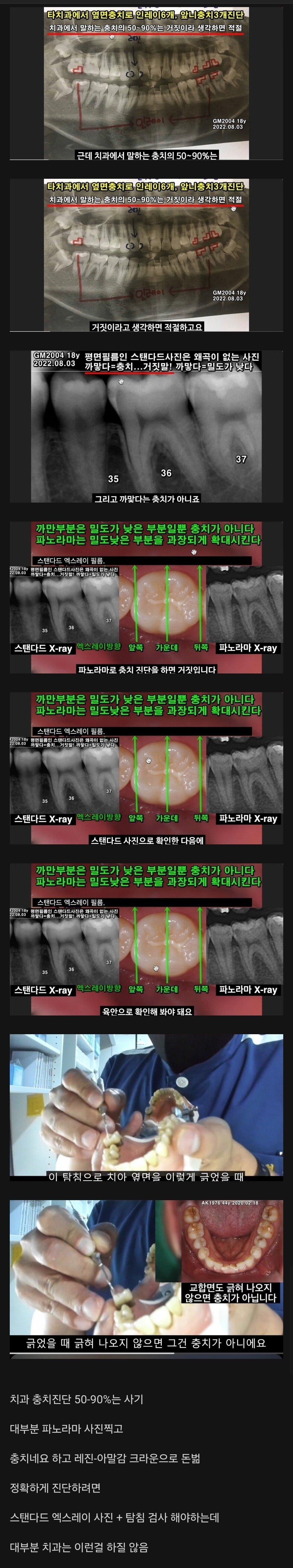 치과 충치 진단 대부분은 사기