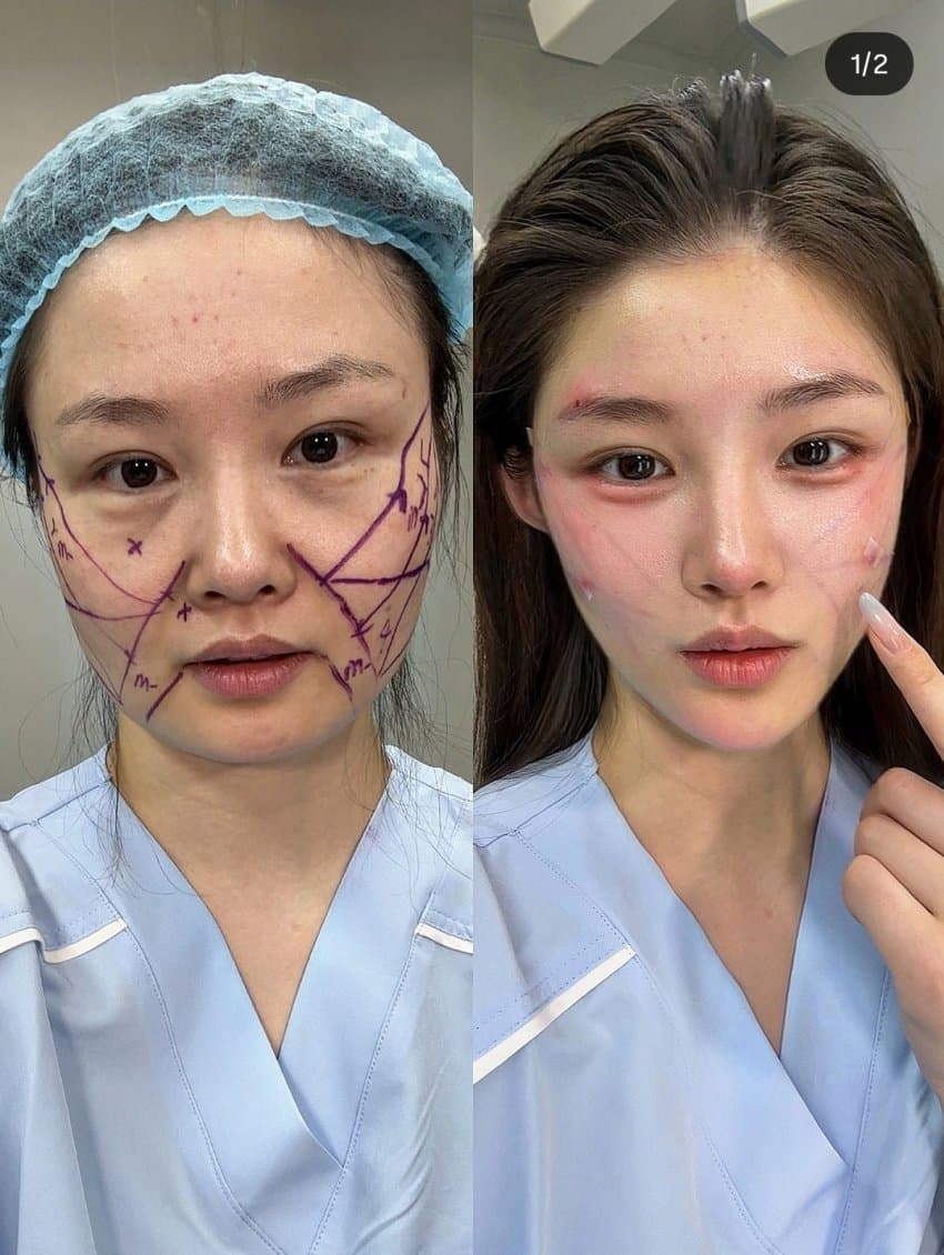 중국 여자 성형 전후
