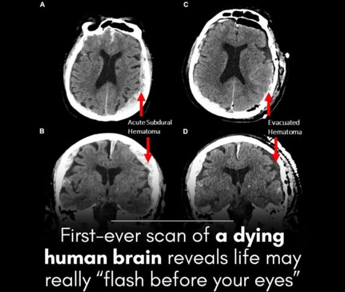 주마등 및 임사체험의 신경학적 근거 발견